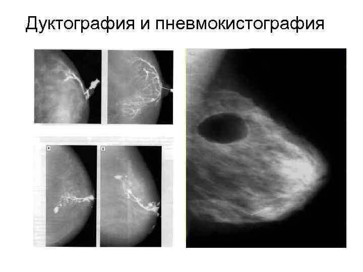 Дуктография и пневмокистография 