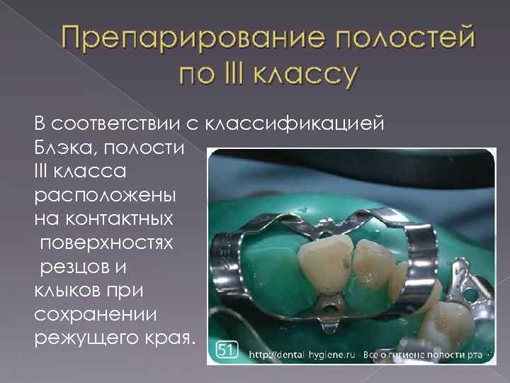 Препарирование полостей по III классу В соответствии с классификацией Блэка, полости III класса расположены