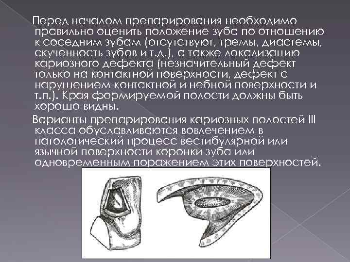 Сэндвич техника пломбирования. Пломбирование полостей 3 класса. Принципы препарирования кариозных полостей.