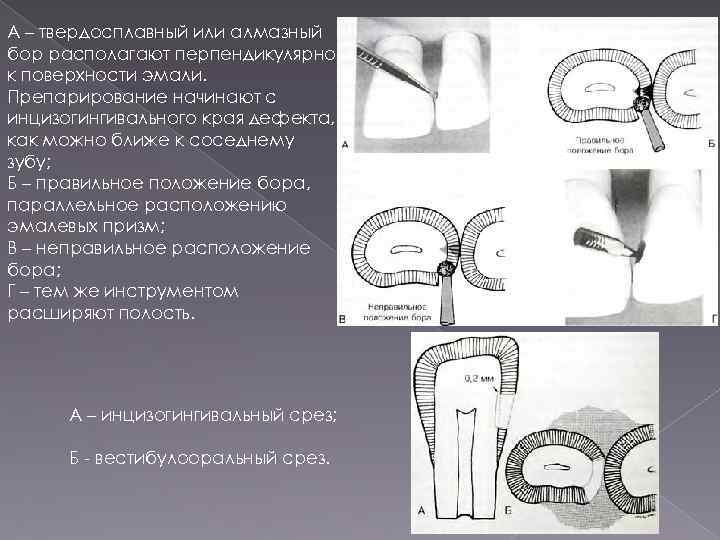 3 класс кариозной полости