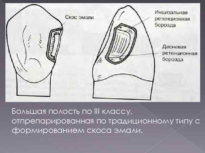 Большая полость по III классу, отпрепарированная по традиционному типу с формированием скоса эмали. 