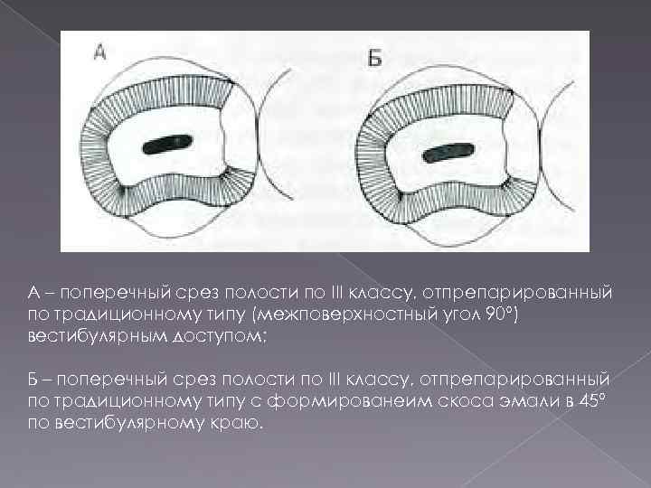 А – поперечный срез полости по III классу, отпрепарированный по традиционному типу (межповерхностный угол