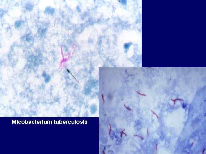 Micobacterium tuberculosis 