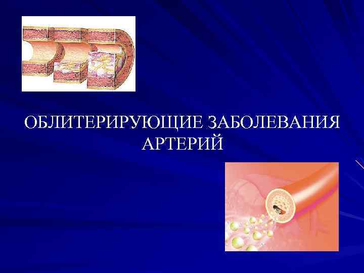 ОБЛИТЕРИРУЮЩИЕ ЗАБОЛЕВАНИЯ АРТЕРИЙ 
