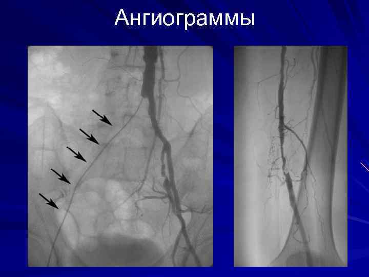 Ангиограммы 