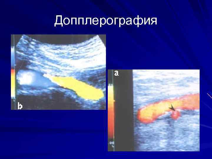 Допплерография 