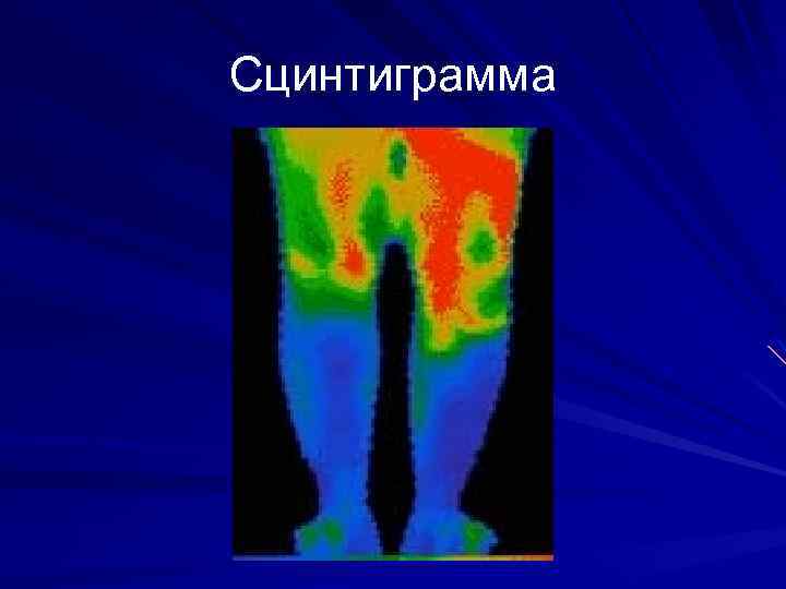 Сцинтиграмма 