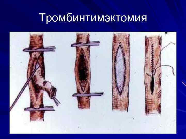 Тромбинтимэктомия 