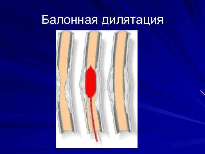 Балонная дилятация 