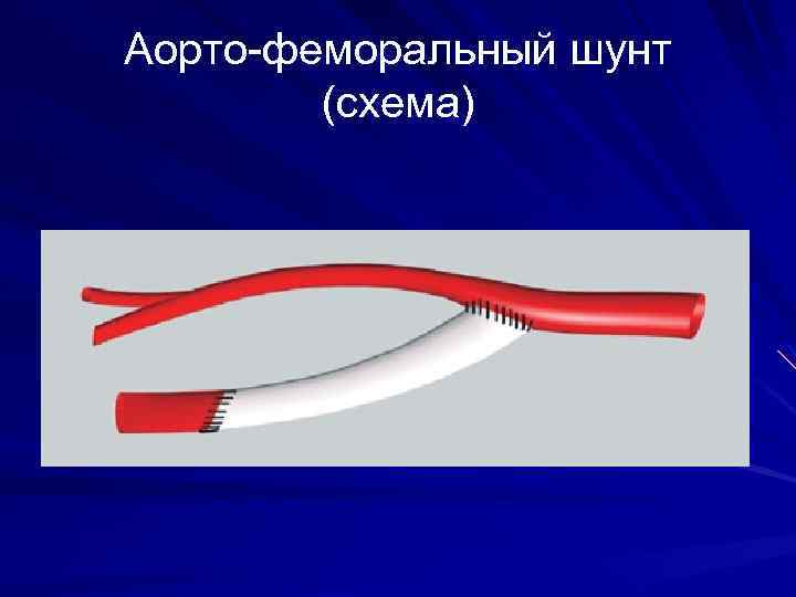 Аорто-феморальный шунт (схема) 
