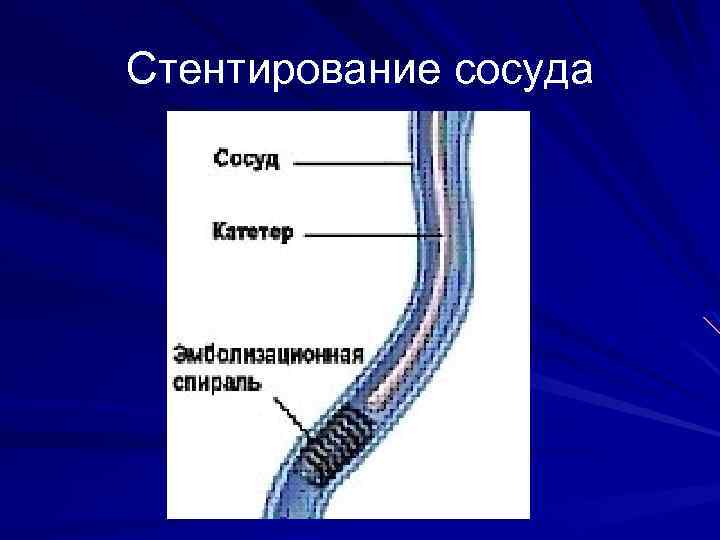 Стентирование сосуда 