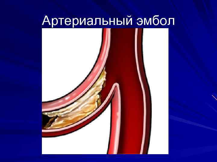 Артериальный эмбол 