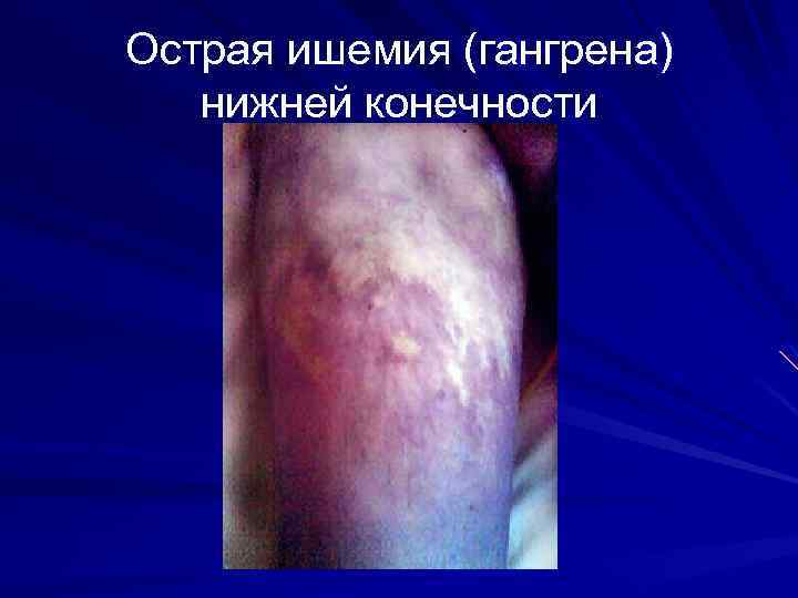 Острая ишемия (гангрена) нижней конечности 
