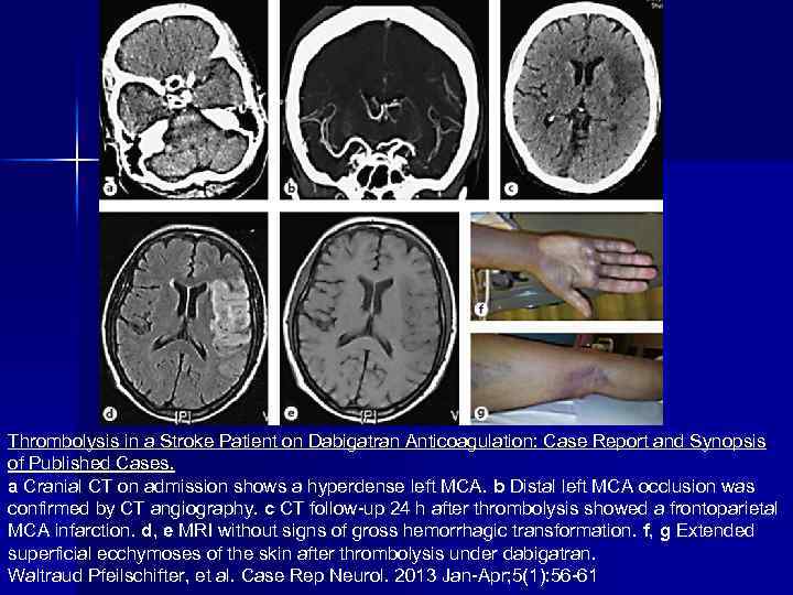 Thrombolysis in a Stroke Patient on Dabigatran Anticoagulation: Case Report and Synopsis of Published