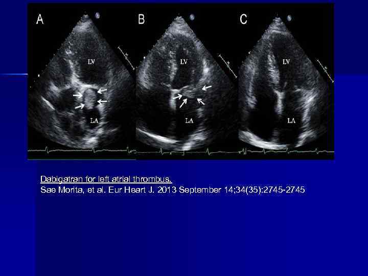 Dabigatran for left atrial thrombus. Sae Morita, et al. Eur Heart J. 2013 September