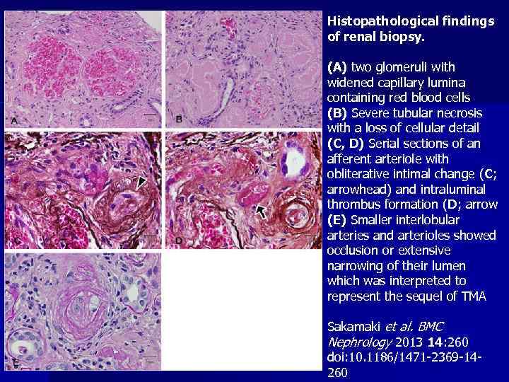 Histopathological findings of renal biopsy. (A) two glomeruli with widened capillary lumina containing red