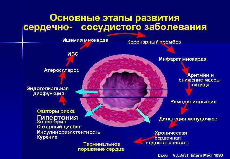 Основные этапы развития сердечно- сосудистого заболевания Ишемия миокарда ИБС Коронарный тромбоз Инфаркт миокарда Атеросклероз