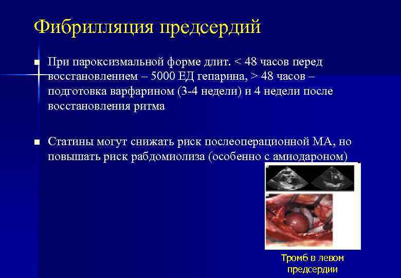 Фибрилляция предсердий n При пароксизмальной форме длит. < 48 часов перед восстановлением – 5000