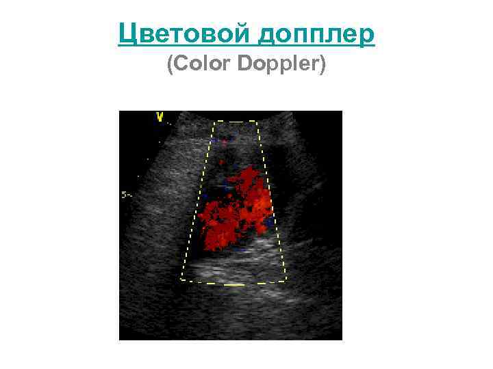 Цветовой допплер (Color Doppler) 