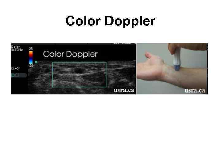 Color Doppler 