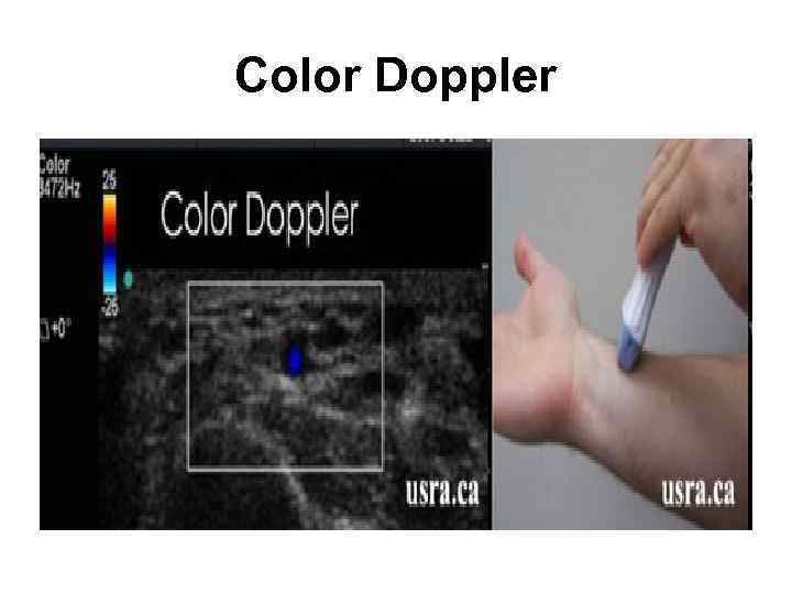 Color Doppler 