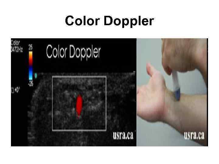 Color Doppler 