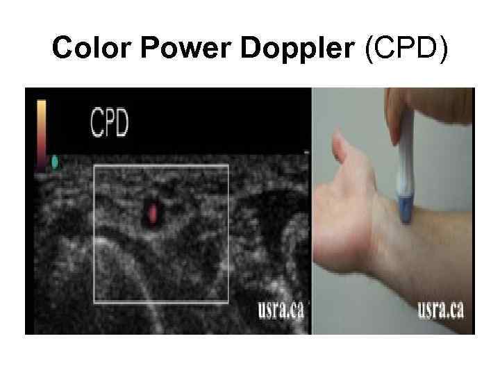 Color Power Doppler (CPD) 