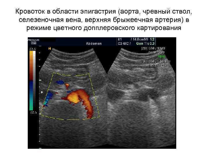 Кровоток в области эпигастрия (аорта, чревный ствол, селезеночная вена, верхняя брыжеечная артерия) в режиме