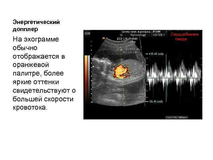 Энергетический допплер На эхограмме обычно отображается в оранжевой палитре, более яркие оттенки свидетельствуют о