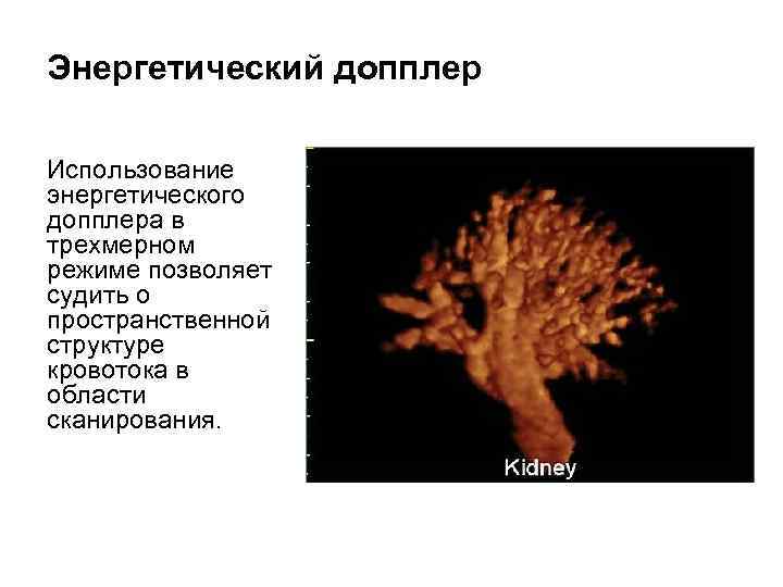 Энергетический допплер Использование энергетического допплера в трехмерном режиме позволяет судить о пространственной структуре кровотока