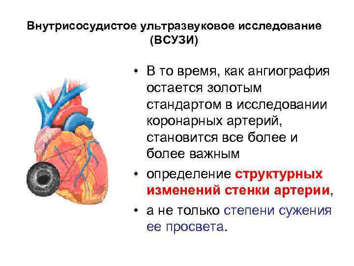 Внутрисосудистое ультразвуковое исследование (ВСУЗИ) • В то время, как ангиография остается золотым стандартом в