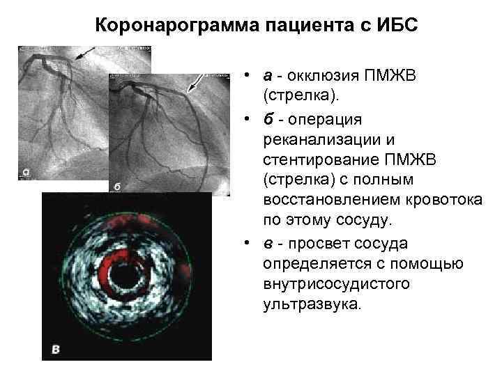 Коронарограмма пациента с ИБС • а - окклюзия ПМЖВ (стрелка). • б - операция