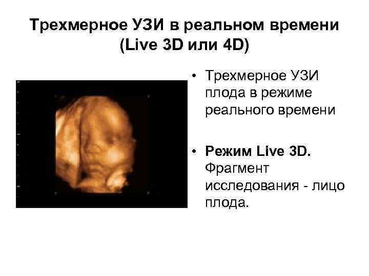 Трехмерное УЗИ в реальном времени (Live 3 D или 4 D) • Трехмерное УЗИ