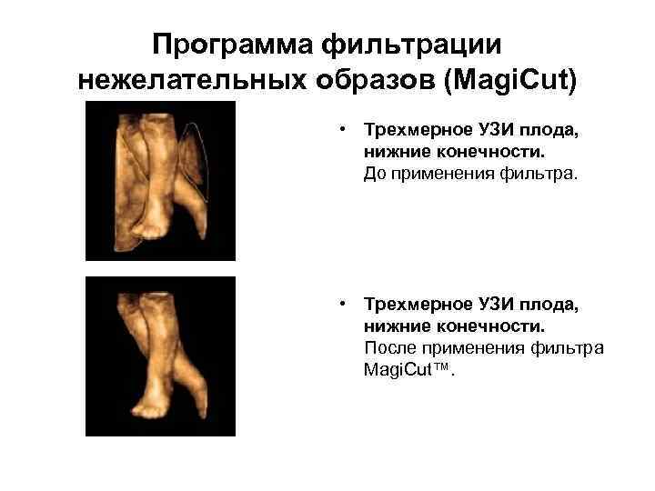 Программа фильтрации нежелательных образов (Magi. Cut) • Трехмерное УЗИ плода, нижние конечности. До применения