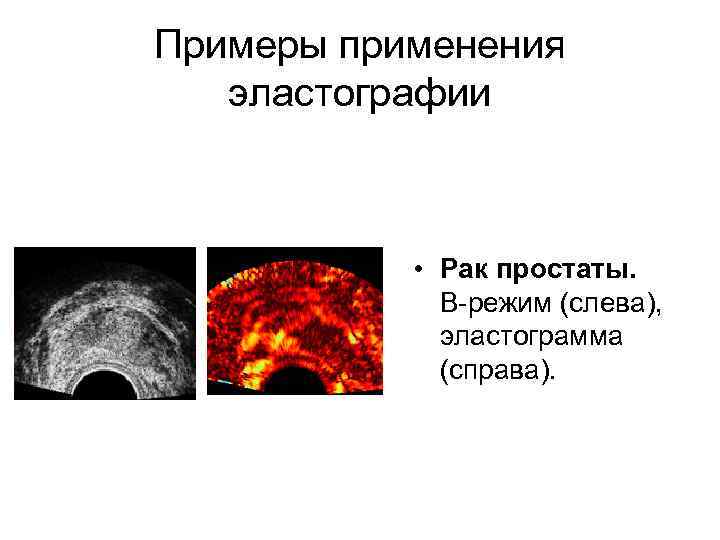 Примеры применения эластографии • Рак простаты. B-режим (слева), эластограмма (справа). 
