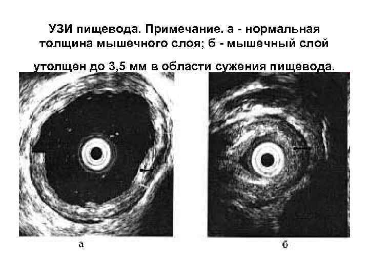 УЗИ пищевода. Примечание. а - нормальная толщина мышечного слоя; б - мышечный слой утолщен