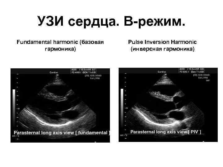 УЗИ сердца. В-режим. Fundamental harmonic (базовая гармоника) Pulse Inversion Harmonic (инверсная гармоника) 