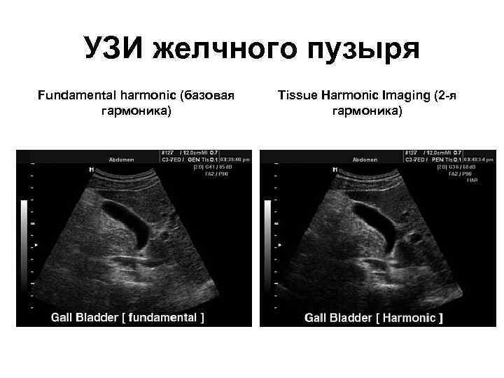 УЗИ желчного пузыря Fundamental harmonic (базовая гармоника) Tissue Harmonic Imaging (2 -я гармоника) 