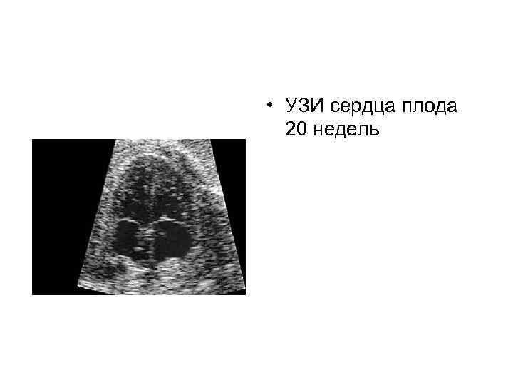  • УЗИ сердца плода 20 недель 