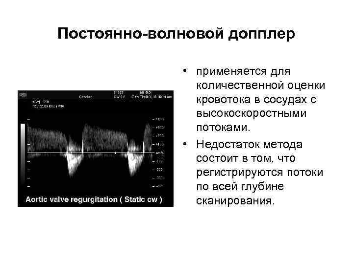 Ультразвуковая диагностика категория. Импульсно волновой доплер УЗИ. Постоянно-волновая допплер-эхокардиография. Импульсно волновой допплер кнопка. Постоянно волновой допплер и импульсно-волновой допплер.