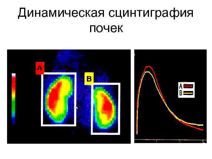 Динамическая сцинтиграфия почек 