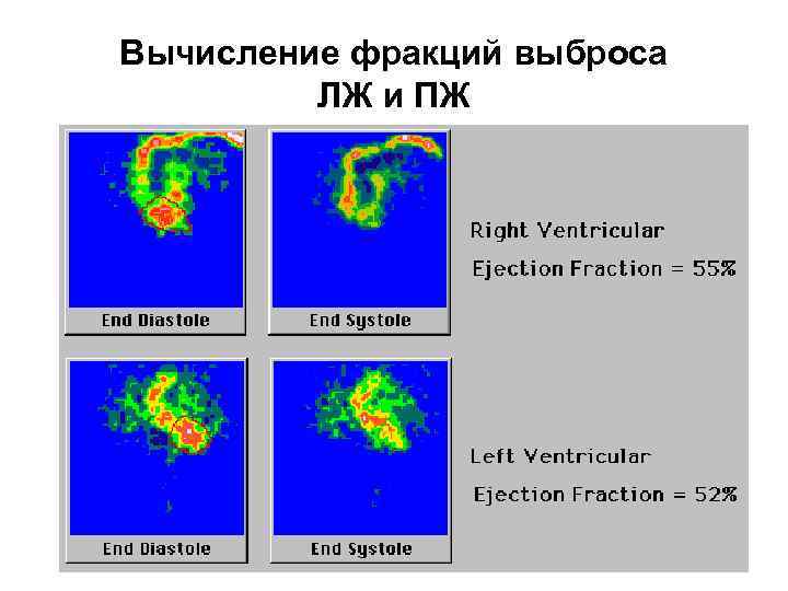 Вычисление фракций выброса ЛЖ и ПЖ 