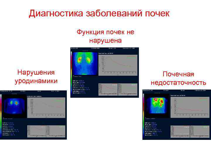 Диагностика заболеваний почек Функция почек не нарушена Нарушения уродинамики Почечная недостаточность 