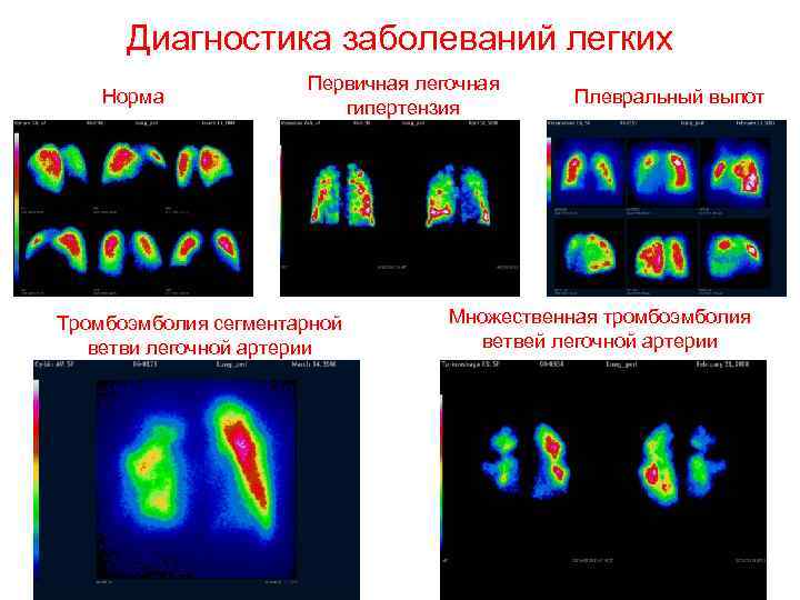 Диагностика заболеваний легких Норма Первичная легочная гипертензия Тромбоэмболия сегментарной ветви легочной артерии Плевральный выпот