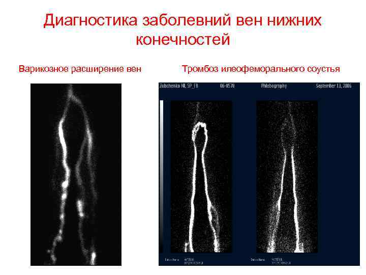 Кт ангиография артерий нижних конечностей