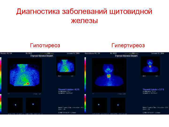 Диагностика заболеваний щитовидной железы Гипотиреоз Гипертиреоз 