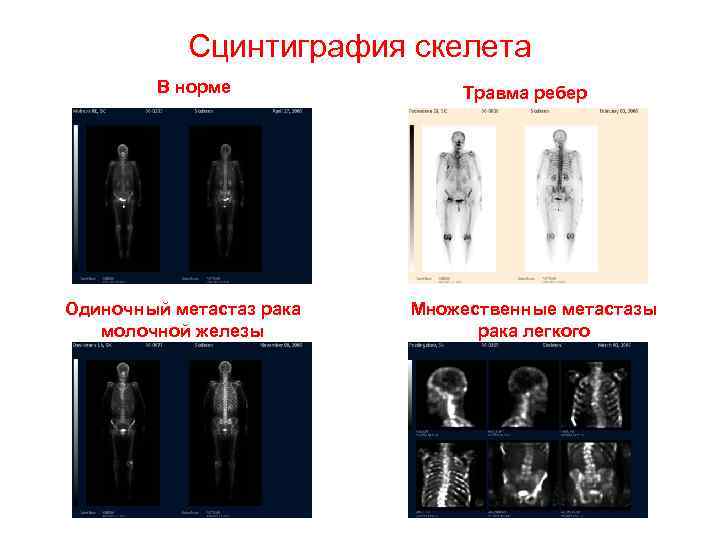 Сцинтиграфия скелета В норме Одиночный метастаз рака молочной железы Травма ребер Множественные метастазы рака