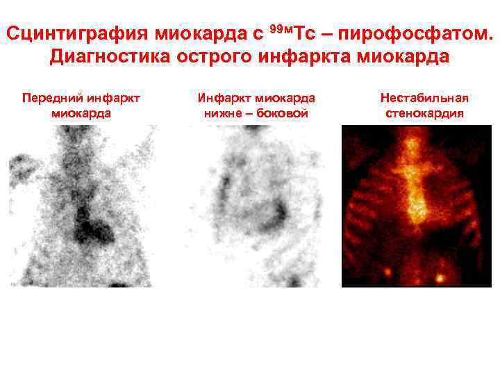 Сцинтиграфия миокарда с 99 м. Тс – пирофосфатом. Диагностика острого инфаркта миокарда Передний инфаркт