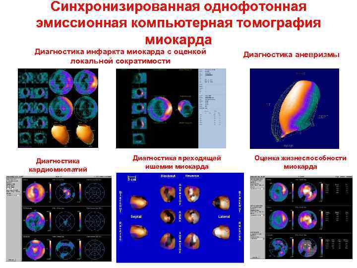 Синхронизированная однофотонная эмиссионная компьютерная томография миокарда Диагностика инфаркта миокарда с оценкой локальной сократимости Диагностика