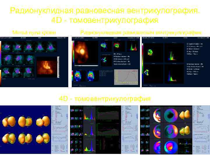 Радионуклидная равновесная вентрикулография. 4 D - томовентрикулография Метка пула крови Радионуклидная равновесная вентрикулография 4